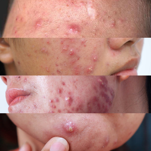 ACNE & PORES - After