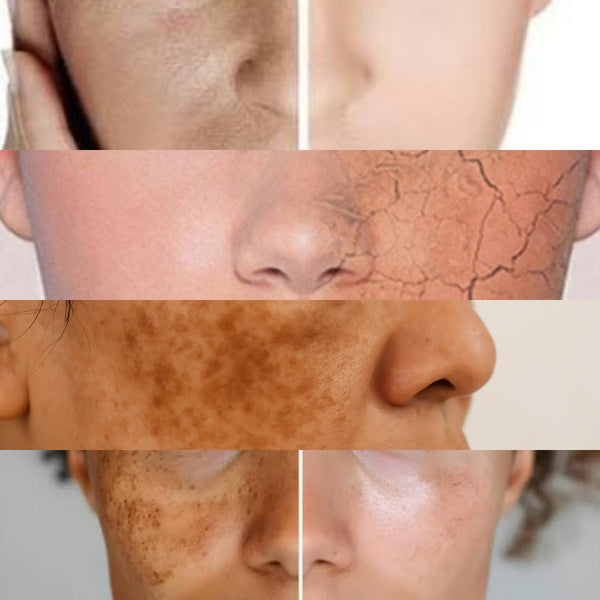 MARKS & DULL SKIN - After