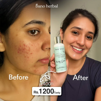 Acne Cure Paste  "Herbal Acne Mask"