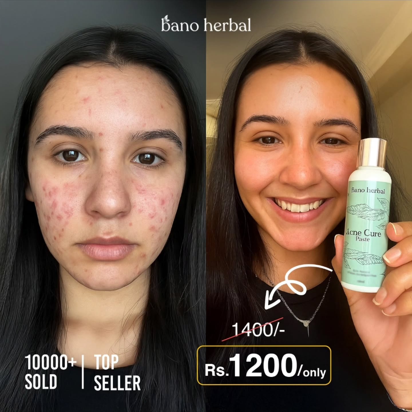 Acne Cure Paste  "Herbal Acne Mask"