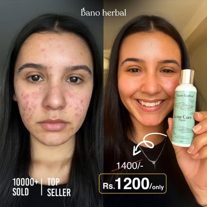 Acne Cure Paste  "Herbal Acne Mask"